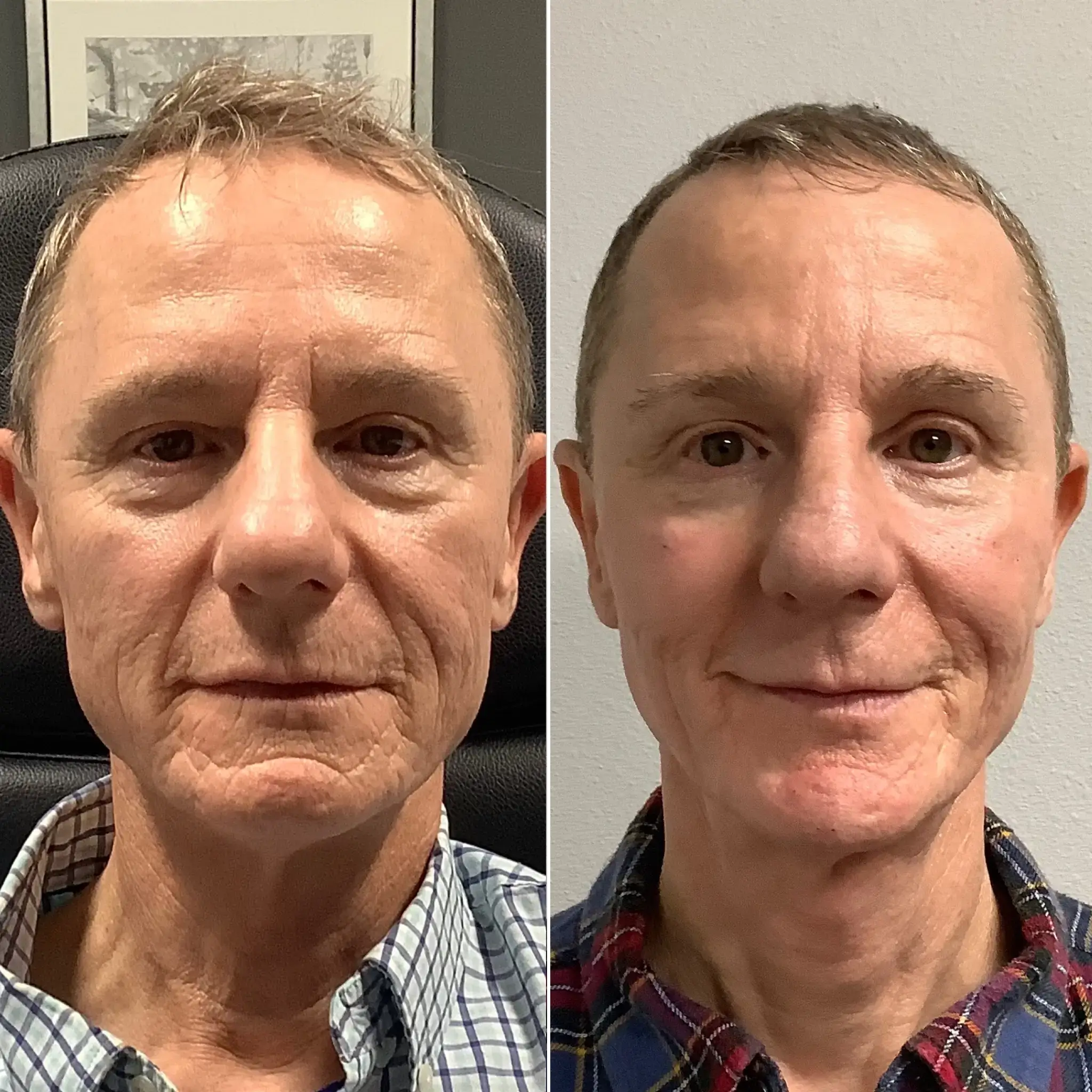 Before and after photos of a man after an anti-aging treatment at a Larkspur Med Spa